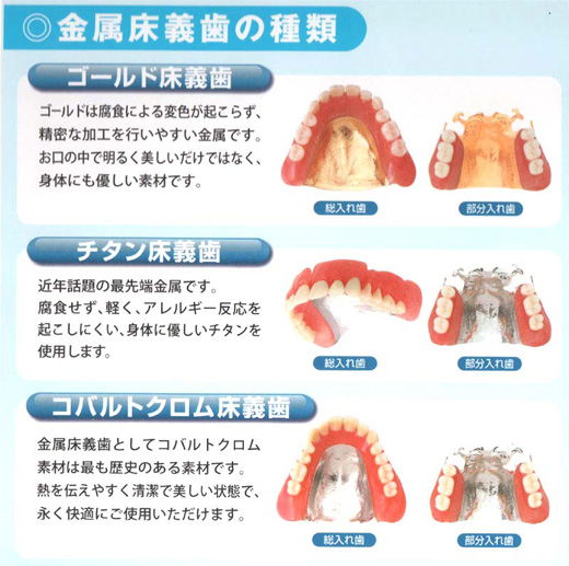 金属床義歯の種類