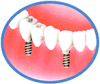 3.人口の歯を被せた状態