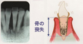 重度の歯周炎